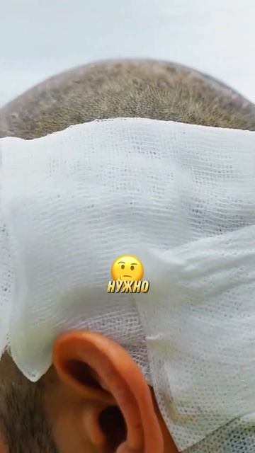 Артур Арутюнян после пересадки волос в GGRAFT #пересадка? смотреть онлайн