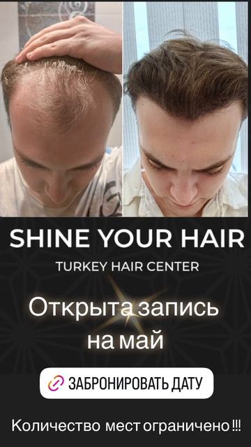 Мы вернем твои волосы #пересадкаволоспитер #бокс #пере смотреть онлайн