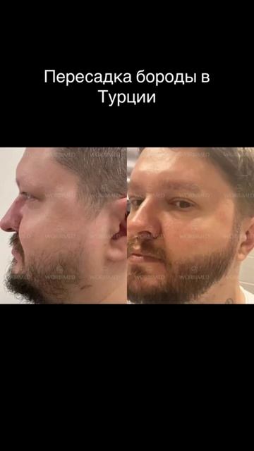 Пересадка бороды в Турции #пересадкаволос #пересадкаб смотреть онлайн