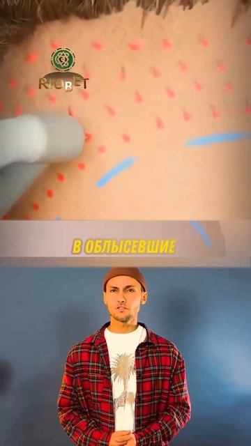 как делают пересадку волос? смотреть онлайн