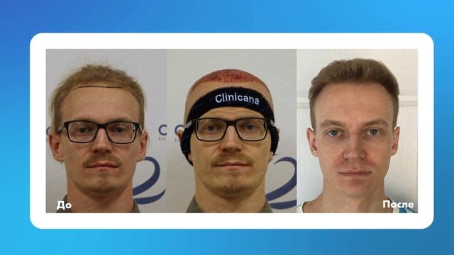 Евгений в Clinicana 4000 графтов смотреть онлайн