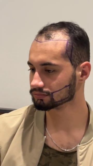 Hair And Beard Transplant | Пересадка Волос и Бороды #beardtransplant #пер?