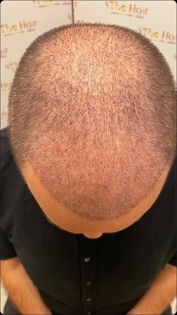 До и после спустя 10 дней. Пересадка волос. #стамбул #тур