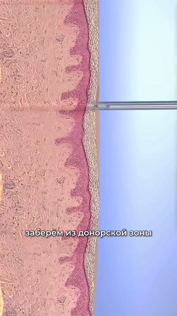 Пересадка волос в Санкт-Петербурге / Страдает ли донор