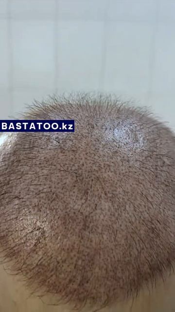 Трихопигментация после 2х пересадок волос. 2/3 процедур