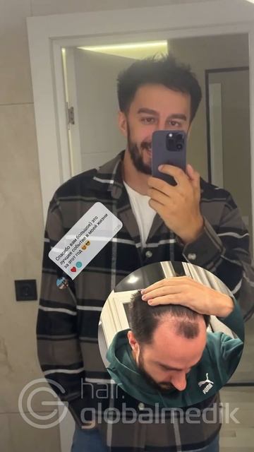 Пересадка волос #globalmedik #пластическаяоперация #переса?