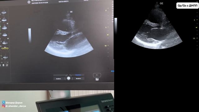 Как измерить Qp/Qs в ЭхоКГ? Простое объяснение