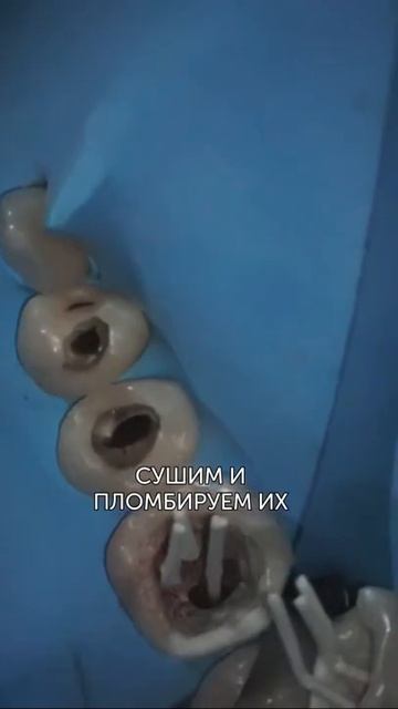 Лечение перед установкой брекетов #shorts смотреть онлайн