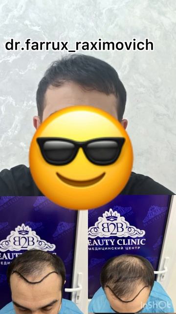 Пересадка волос соч э иш soch ekishWhatsApp telegram +998996373335 смотреть онлайн