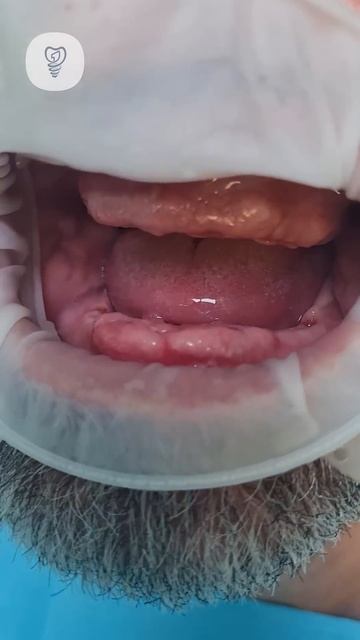 Удалить 14 зубов, поставить 12 имплантатов, сделать 2 син смотреть онлайн