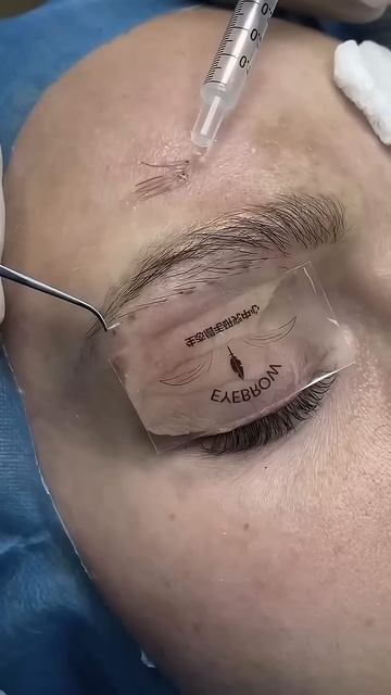 Eyebrow transplant#Kaş ekimi#Trasplante de cejas#Transplante de sobrancelha#Транспланта смотреть онлайн