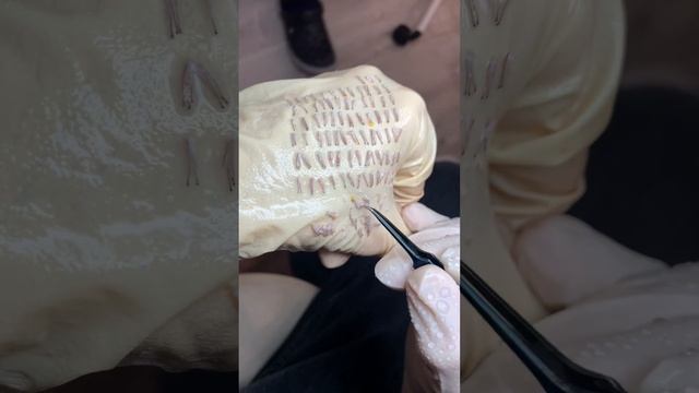 Пересадка волос в Москве! Да и после первой процедуры смотреть онлайн