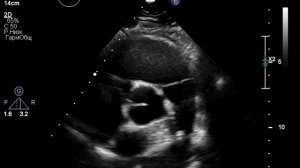 Окклюдер артериального протока. Операция 10 лет назад в возрасте 25 лет.  Бессимптомный ОАП.