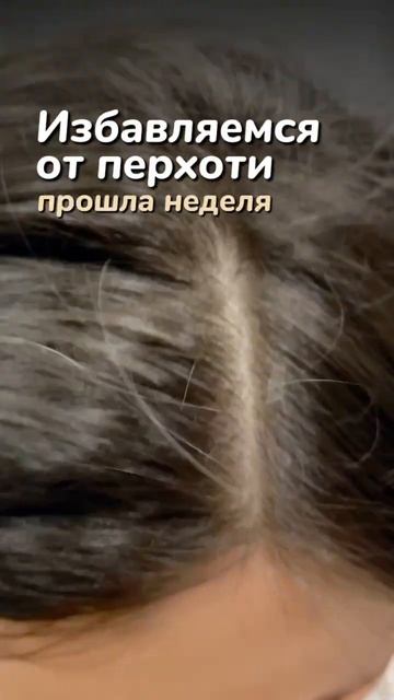 Одно средство и ты забудешь о перхоти WB #208745988 #перхоть смотреть онлайн
