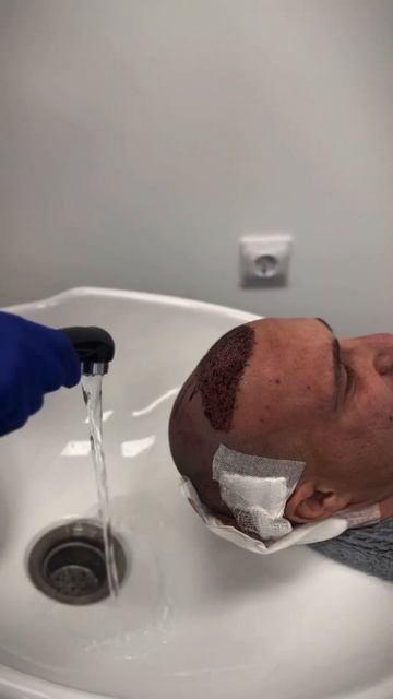 Смотрите, как проходит пересадка волос в нашей клиник?