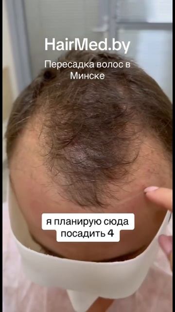 HairMed.by | пересадка волос в Минске.