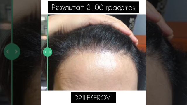 Результаты пересадки волос методом FUE 4 | До и После