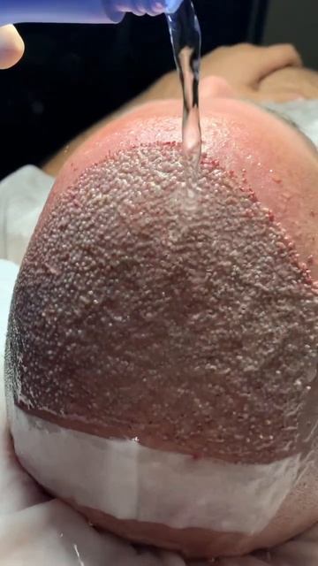 Пересадка волос после операции в Москве👩🦲👨#shorts