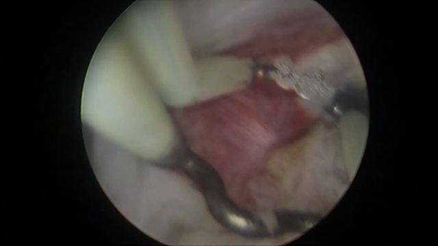 Стриктура уретероцистоанастомоза лимфоцере после тр? смотреть онлайн