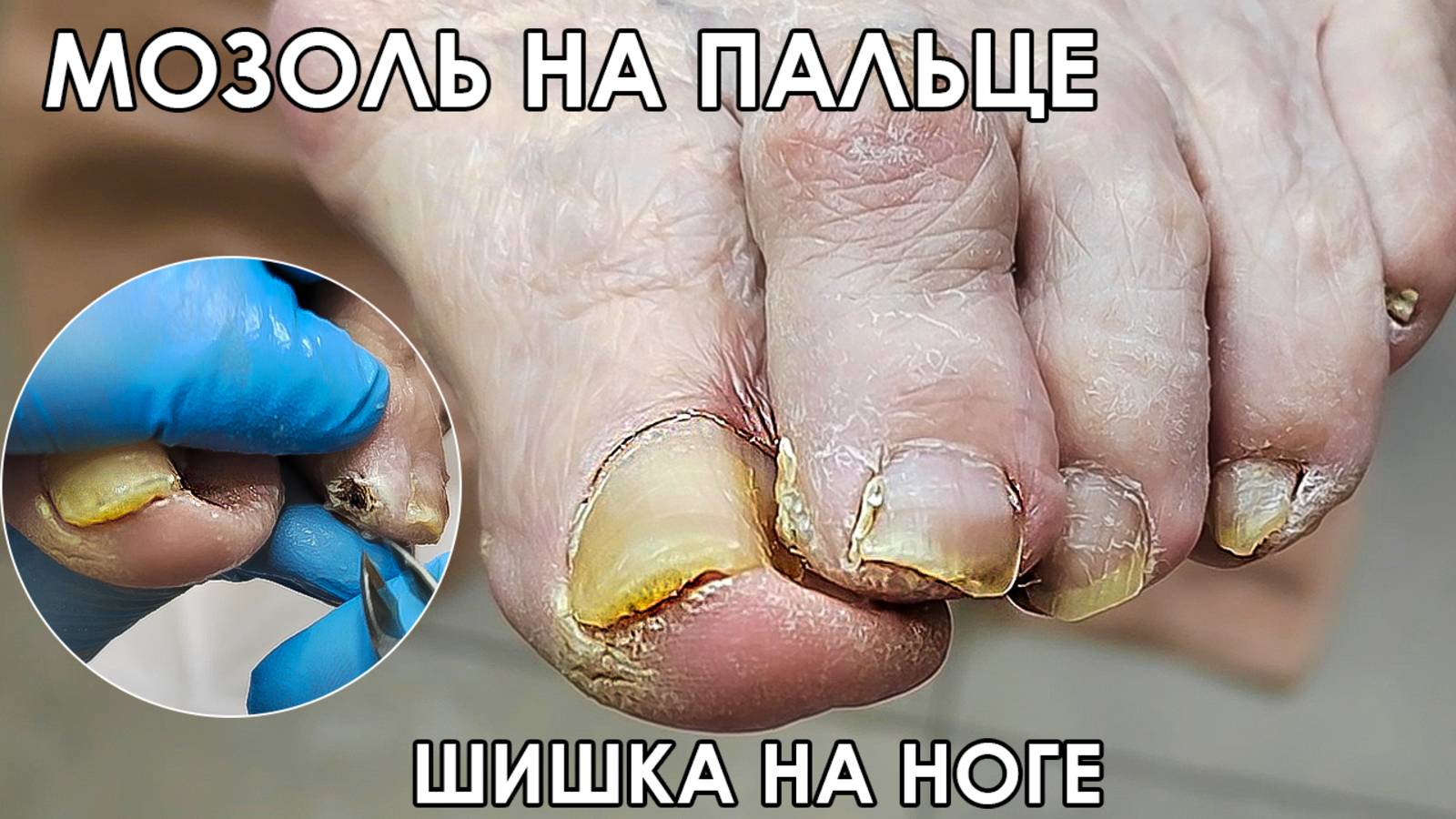 МОЗОЛЬ НА ПАЛЬЦЕ! ГРИБОК НА НОГТЯХ!