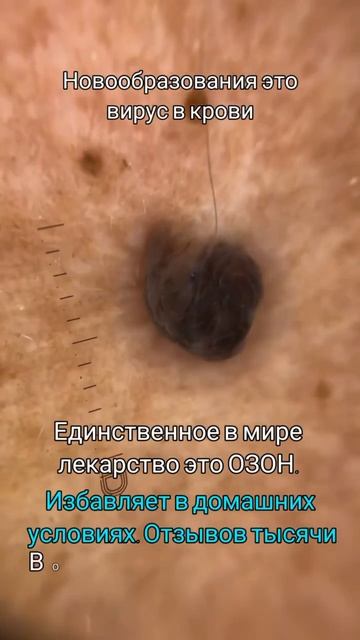 Это обязательно. Убирать вирус внутри. СПОСОБ ЕСТЬ. #ви смотреть онлайн