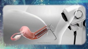 Дисплазия шейки матки это рак или нет?