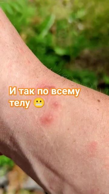 Ожоги от Борщевика смотреть онлайн