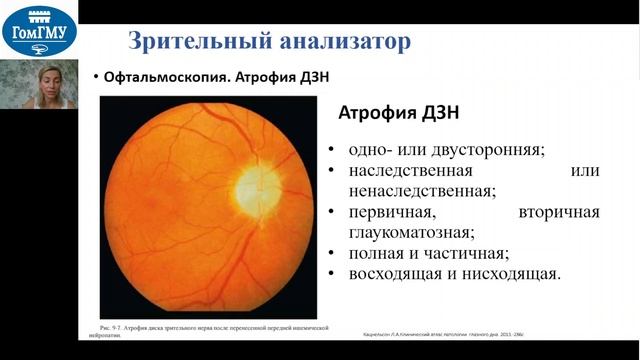 Зрительный нерв методы исследования, симптомы пораже? смотреть онлайн