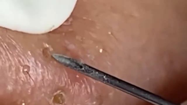 Прыщи / Огромные прыщи / Релакс с акне / Выдавливание пр