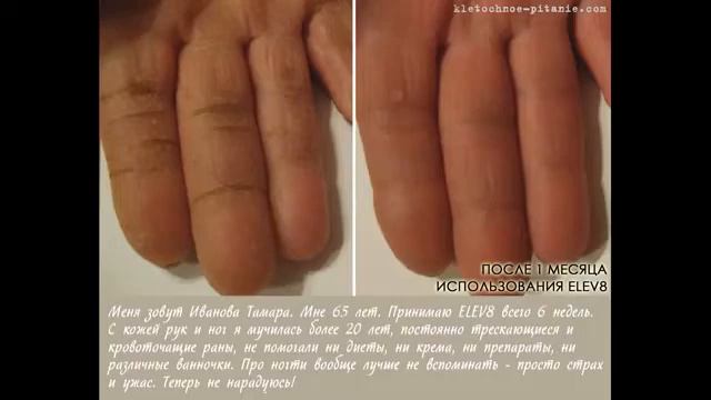 #Псориаз, #витилиго, #кожные заболевания смотреть онлайн