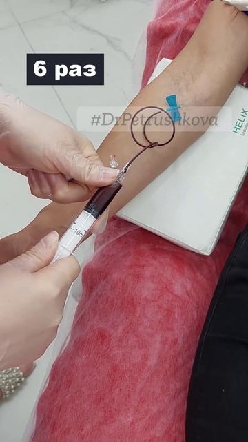 Когда делаешь плазму 6 раз за день #плазмолифтинг #плаз смотреть онлайн