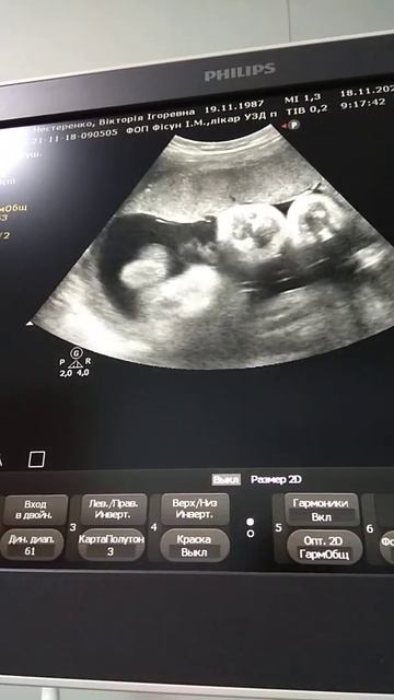 УЗИ 33 недели ( третий скрининг) 18.11.21 смотреть онлайн