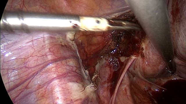 Лапароскопическая экстирпация матки с придатками (са? смотреть онлайн