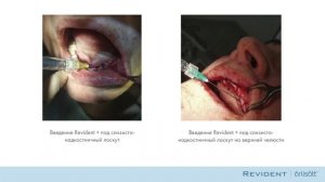 REVIDENT «Гиалуроновая кислота в стоматологии. Revident и Revident