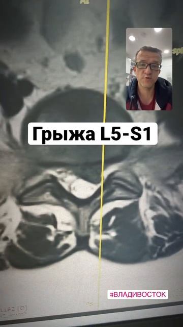 Грыжа L5-S1 смотреть онлайн