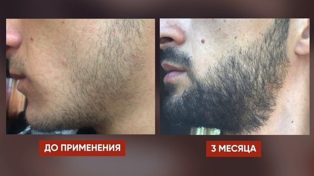 Зарастил ЩЕКИ за 5 месяцев | Средство для роста бороды смотреть онлайн
