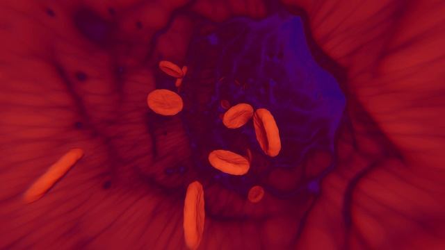 Сердечно-сосудистый риск у диабетиков, Триглицериды, ЛПНП смотреть онлайн