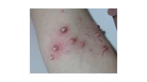 Вот самые заразные вирусные заболевания кожи! ПЕРЕДАЕ