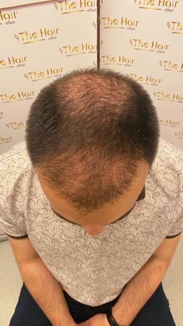 Результат спустя 4 месяца. Пересадка волос. #стамбул #т?