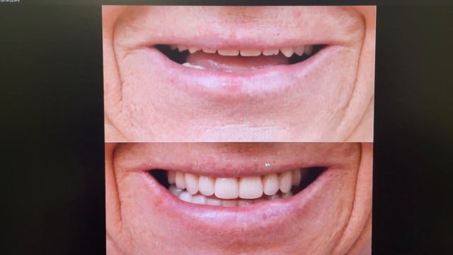 Протезирование зубов. КОГДА делать новые протезы смотреть онлайн