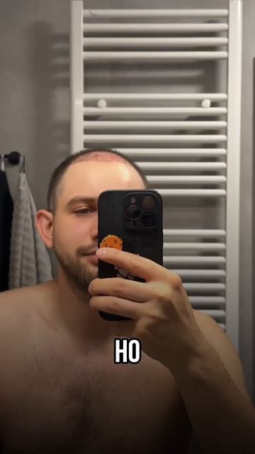 Ровно месяц после пересадки #волосы #пересадкаволосвт