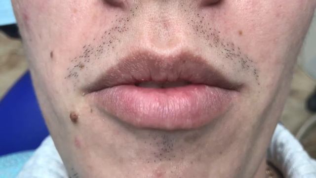 Голливудская улыбка! Виниры , Люминиры, ультраниры, нановиниры. смотреть онлайн