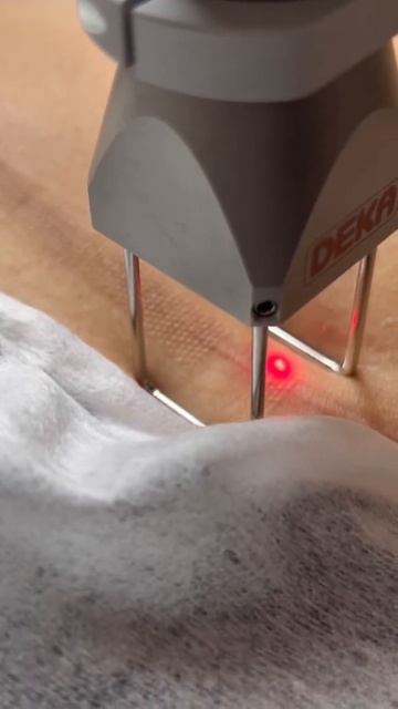 Клиника VALLISTEP,Кострома Лазерная шлифовка рубцов