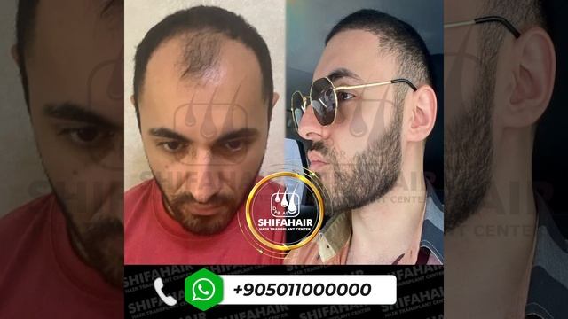 Опыт одного из наших клиентов по пересадке волос. Запи