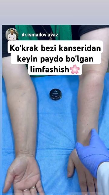 Limfashish qo'lda #лимфостаз #лимфедем #limfedema смотреть онлайн