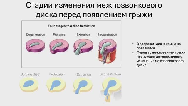 Корешковый синдром важнее грыжи? | Опасность радикулопатии смотреть онлайн