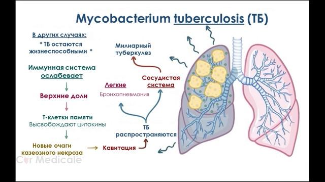 Туберкулез и Mycobacterium tuberculosis смотреть онлайн