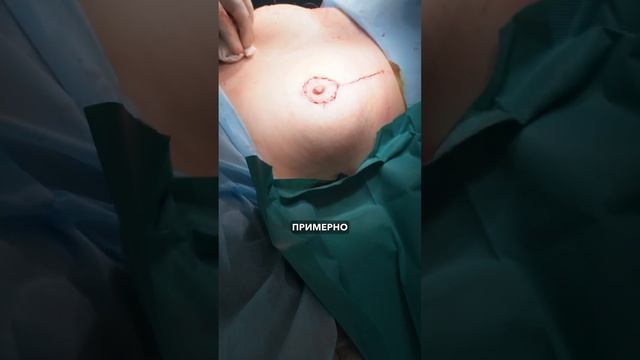 Химиотерапия при раке молочной железы. Отвечаю на воп? смотреть онлайн