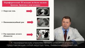 Рак лёгких. Первые симптомы и диагностика.