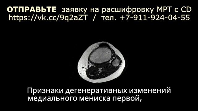 БОЛИ В КОЛЕНЕ при разрыве мениска 3 степени и ЖИДКОСТИ В КОЛЕНЕ на РАСШИФРОВКЕ МРТ коленного сустав